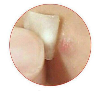 Acne Pimple Patches by RX Beauty Vault - 56 Count