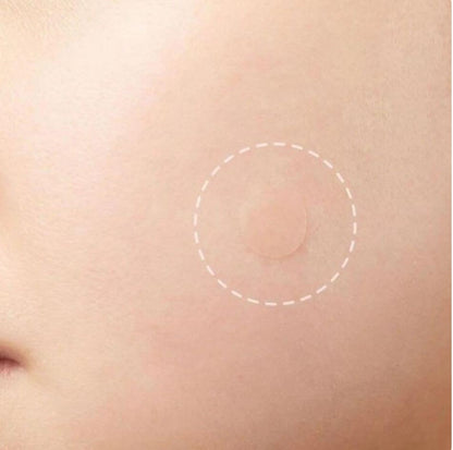 Acne Pimple Patches by RX Beauty Vault - 56 Count